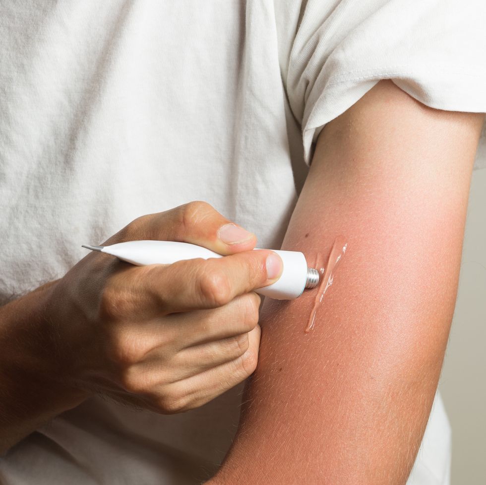 Ini Sejumlah Tips Untuk Mengatasi Sunburn Lebih Cepat