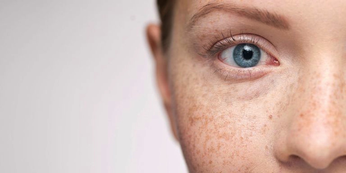 Tentang Freckles, Melasma, dan Hiperpigmentasi