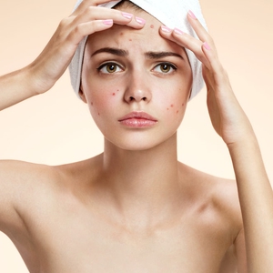 6 Kebiasaan Buruk Penyebab Jerawat