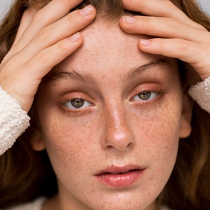 Jerawat di Pelipis? Ini 5 Penyebab Utamanya