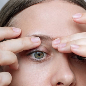 Kenali Penyebab Milia di Wajah dan Cara Mengatasinya