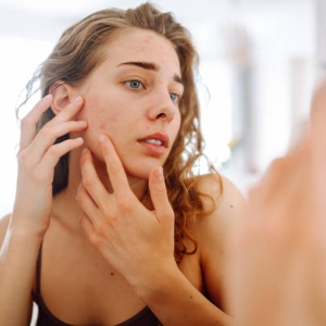 Cara Mengatasi Jerawat Batu Tanpa Ribet