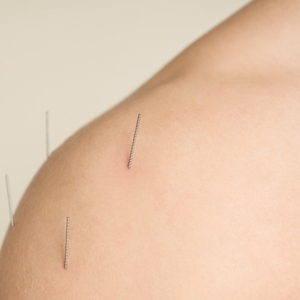 Manfaat Akupunktur yang Tidak Banyak Diketahui Dari Relaksasi Pikiran hingga Kecantikan Wajah