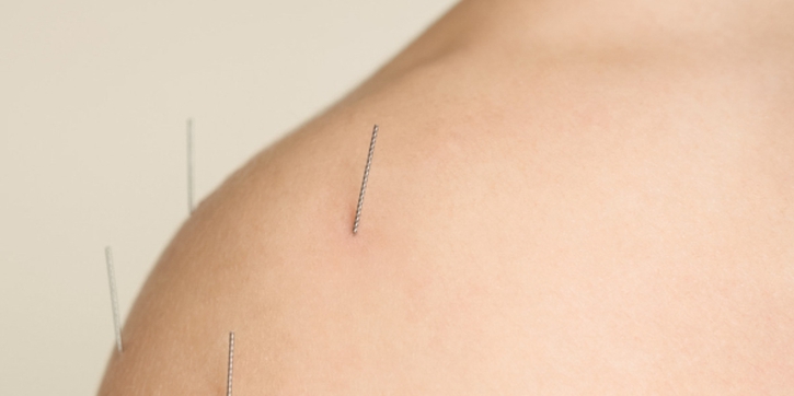 Manfaat Akupunktur yang Tidak Banyak Diketahui Dari Relaksasi Pikiran hingga Kecantikan Wajah