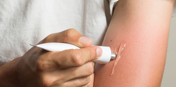 Ini Sejumlah Tips Untuk Mengatasi Sunburn Lebih Cepat
