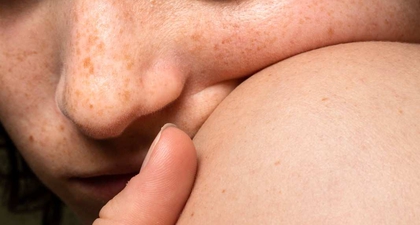 Kenali Hiperpigmentasi Kulit dan Solusi Ampuh untuk Mengatasinya