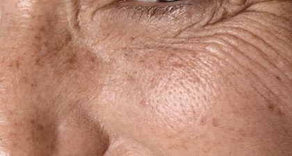 10 Penyebab Flek Hitam di Wajah yang Sering Diabaikan, Waspadai Sebelum Terlambat