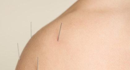 Manfaat Akupunktur yang Tidak Banyak Diketahui Dari Relaksasi Pikiran hingga Kecantikan Wajah