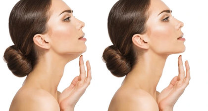 Cara Menghilangkan Double Chin Secara Efektif