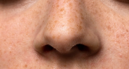 Cara Jitu Membantu Mengelupas Flek Hitam dengan Cepat dan Aman