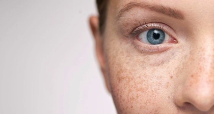 Tentang Freckles, Melasma, dan Hiperpigmentasi